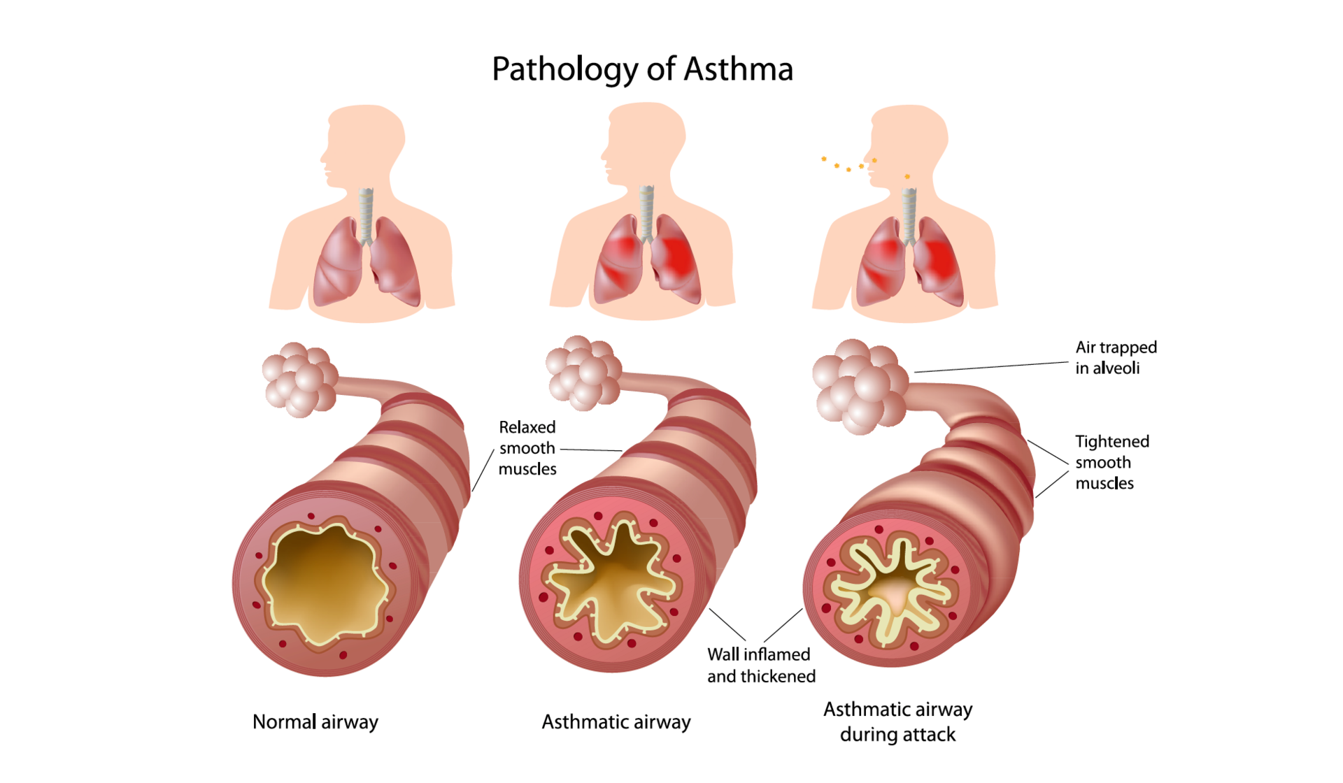 Развитие астмы у детей. Период предвестников бронхиальной астмы у детей. Осложнения приступа бронхиальной астмы. Осложнения аллергической бронхиальной астмы. Осложнения бронхиальной астмы картинки.